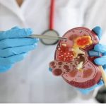 ❖ SALUD▮Nefritis lúpica puede avanzar sin síntomas y afectar los riñones